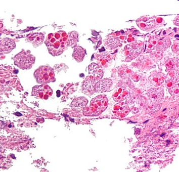 Entamoeba histolytica